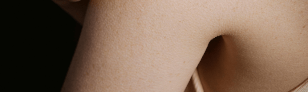 Common Causes of Eczema: Understanding What Triggers Flare-Ups